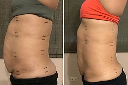 علاج تفتيت الدهون بالليزر في الرياض والمملكة العربية السعودية