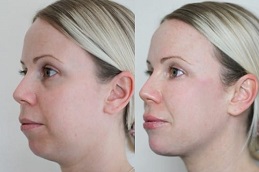 علاج خط الفك في الرياض