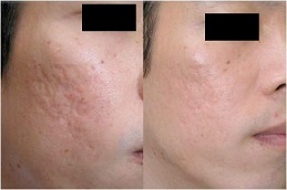 علاج ديرما رولر في الرياض والمملكة العربية السعودية