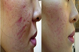 علاج ديرما رولر في الرياض