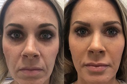 علاج زيومين في الرياض