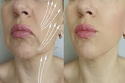 علاج شد الوجه بالخيوط في الرياض والمملكة العربية السعودية