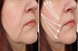 علاج شد الوجه بالخيوط في الرياض