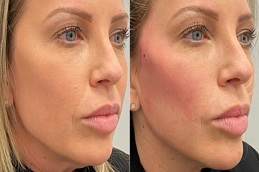 علاج شد الوجه بخيوط السكر في الرياض والمملكة العربية السعودية