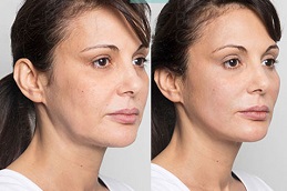 علاج شد الوجه بخيوط السكر في الرياض