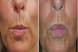 علاج شفاه المدخنين في الرياض والمملكة العربية السعودية