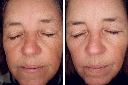 علاج عامل النمو المركز في الرياض والمملكة العربية السعودية