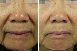 علاج عامل النمو المركز في الرياض