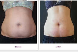 علاج فيلاشيب 3 في الرياض والمملكة العربية السعودية