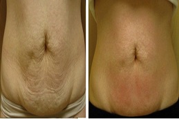 علاج فيلاشيب 3 في الرياض