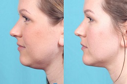 علاج كيبيلا للذقن المزدوج في الرياض والمملكة العربية السعودية