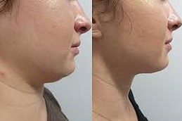 علاج كيبيلا للذقن المزدوج في الرياض