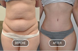 علاج ليبوماتيك في الرياض، المملكة العربية السعودية