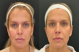 علاج مورفيوس ٨ في الرياض