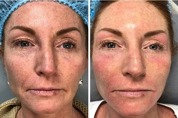 علاج ميزوغولد بالختم في الرياض والمملكة العربية السعودية