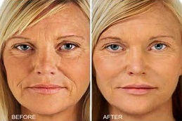 علاج ميزوغولد بالختم في الرياض