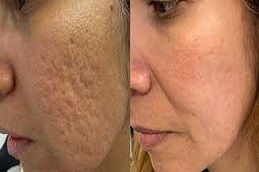 علاج ندبات حب الشباب بالإبر الدقيقة في الرياض