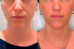 علاج نفرتيتي لشد الفك في الرياض والمملكة العربية السعودية