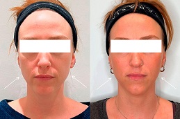 علاج نفرتيتي لشد الفك في الرياض