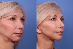 علاجات مكافحة الشيخوخة في الرياض