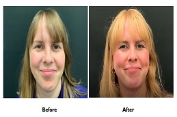 عملية تجميل الغمازات في الرياض والمملكة العربية السعودية