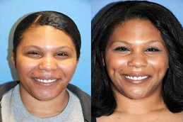 عملية تجميل الغمازات في الرياض