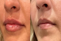 فوتونا 4D لتكبير الشفاه في الرياض والمملكة العربية السعودية