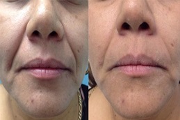 فوتونا 4D لتكبير الشفاه في الرياض