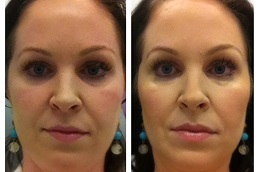 فولوما فيلر في الرياض والمملكة العربية السعودية