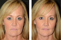 فولوما فيلر في الرياض