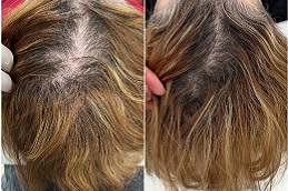 فيلر الشعر في الرياض والمملكة العربية السعودية