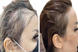 فيلر الشعر في الرياض