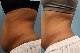 نحت الجسم بتقنية سكالبشور في الرياض والمملكة العربية السعودية