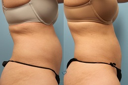 نحت الجسم بتقنية سكالبشور في الرياض