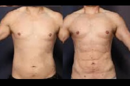 نحت الجسم عالي الدقة في الرياض