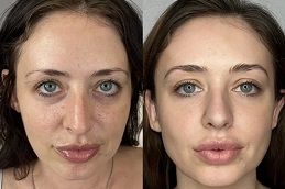 نحت الوجه في الرياض