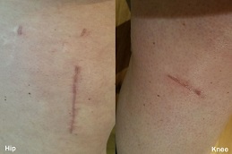 ندوب ما بعد الجراحة في الرياض والمملكة العربية السعودية