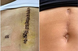 ندوب ما بعد الجراحة في الرياض