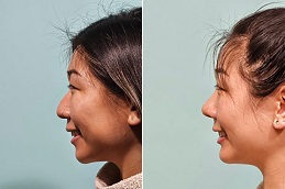 أفضل تكلفة لجراحي تجميل الأنف