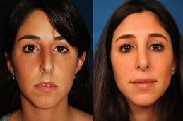 أفضل تكلفة لعملية تجميل الأنف في الرياض والمملكة العربية السعودية