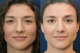 أفضل تكلفة لعملية تجميل الأنف في الرياض