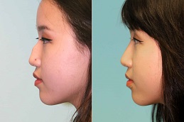 تكلفة جراحي تجميل الأنف