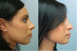 تكلفة عملية تجميل الأنف في الرياض والمملكة العربية السعودية