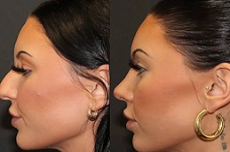 تكلفة عملية تجميل الأنف في الرياض