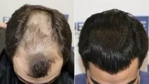 Hair Transplant in Riyadh , Jeddah And Saudi Arabia