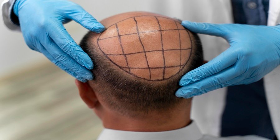 Hair Transplant in Riyadh