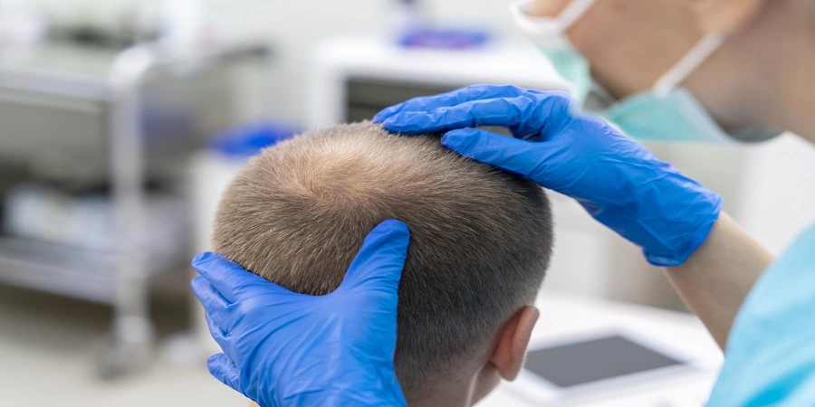 Hair Transplant Cost in Riyadh