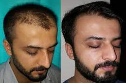 Hair Transplant in Riyadh , Jeddah And Saudi Arabia