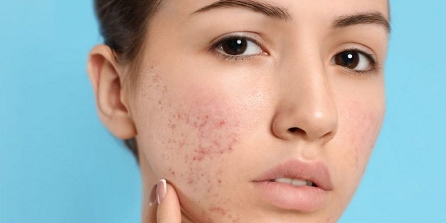 Acne Scar Treatment in Riyadh & Saudi Arabia Cost