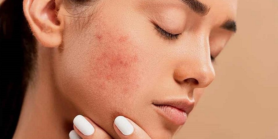 Acne Treatment in Riyadh Saudi Arabia Riyadh Clinic